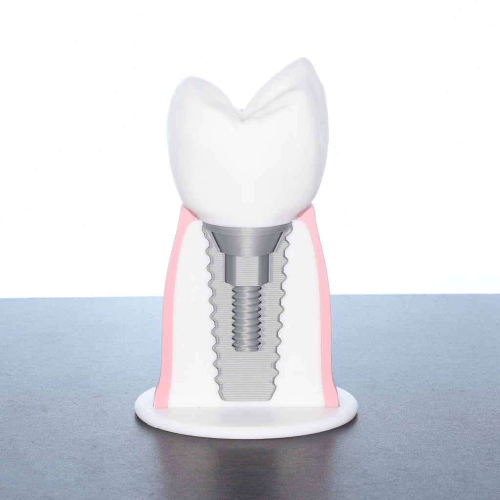 Dental Implant